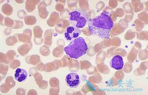 白血病 白血病