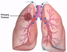 ����ͻ�为�ɣ�TMB���Ƿ��Ӱ���Сϸ���ΰ����ߵ�Ԥ��