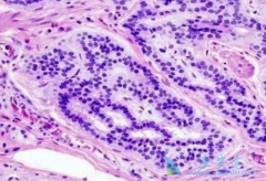 ��������(Caprelsa)���ض�����;����GBM��������Ч������