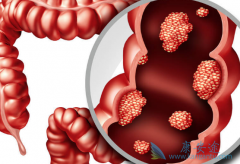 ��������(Capecitabine)��Ⱦ���5FU�Ի��߶������Ƹ���