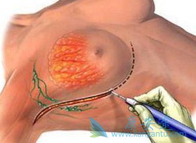 阿那曲唑 阿那曲唑
