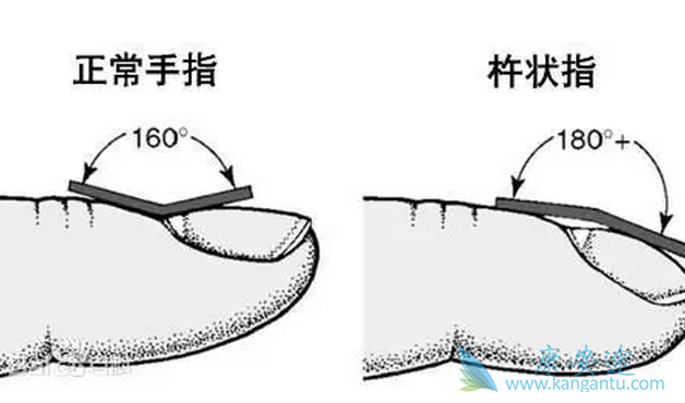肺癌的症状 肺癌的症状
