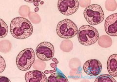 �����ͽ�����������(Imatinib)������׼����Ӧ֢�ǲ�ͬ��