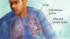 �ΰ���ҩAZD3759��AZD9291������Ч����ʲô��ͬ