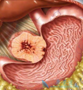 ������/�������Ḩ������GIST�����ܸ����޸�����������