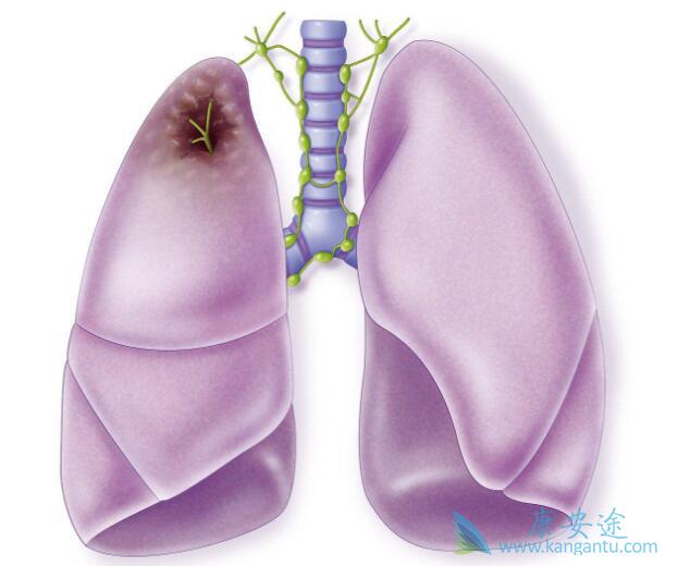 肺癌肝转移 肺癌肝转移