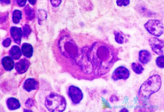 ��³����(Ibrutinib)��ʹ�������ܰ������ߵ�PFS����2��