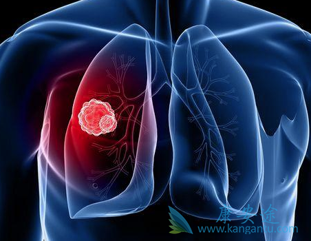 非小细胞肺癌 非小细胞肺癌