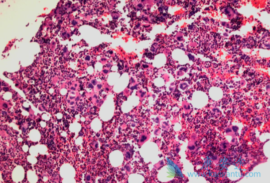 鲁索替尼 鲁索替尼