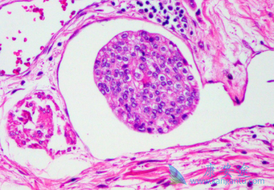 拉帕替尼 拉帕替尼