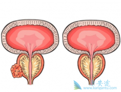 ����³��(enzalutamide)������Ч�����������ʲô�仯