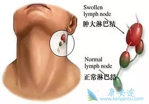 淋巴癌症状 淋巴癌症状