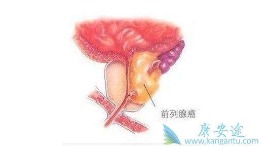 前列腺癌症状 前列腺癌症状