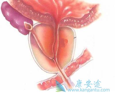 膀胱癌治疗 膀胱癌治疗