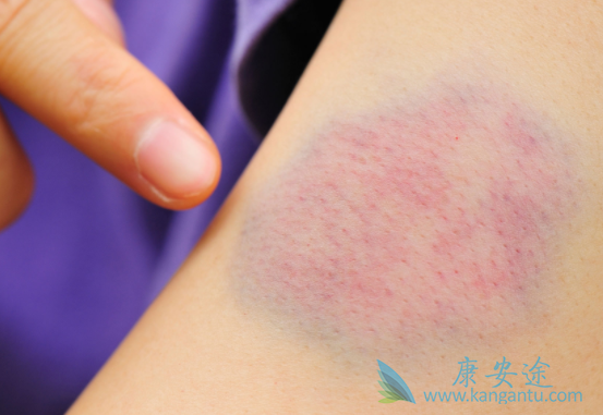 ��Ѫ���ĳ���֢״