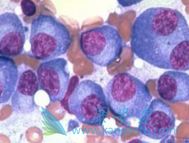 骨髓瘤症状 骨髓瘤症状