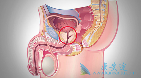 前列腺癌患者 前列腺癌患者