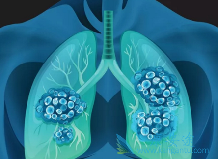 非小细胞肺癌 非小细胞肺癌