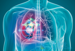 ��������(Poziotinib)���ƺ���ͻ��ΰ�����Ч����ô��