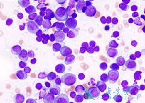 多发性骨髓瘤 多发性骨髓瘤