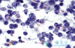 ��VEGF�Ϳ�PD-L1����ҩ�����Ͽ����Сϸ���ΰ�������Ч��