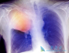 ���߸���δ���ALK���Ƽ�Lorlatinib�Ĳ�����Ӧ