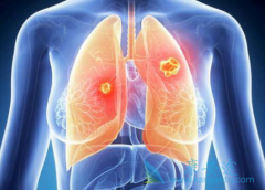 ��������(Lorlatinib)�Գ������ת�ƻ���Ч����ô��