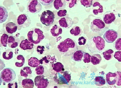 ��Ѫ����ʹ֢״��෢�Թ������Ĺ�ʹ֢״��ʲô����