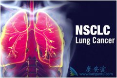 PD-1������ҩ���Ƴ��ε����ڷ�Сϸ���ΰ�������Ч�Ƿ�����