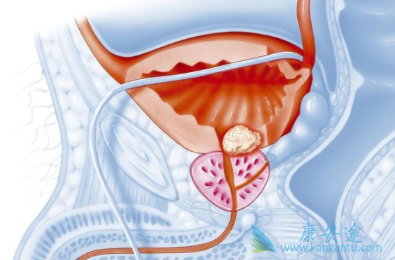 前列腺癌 前列腺癌