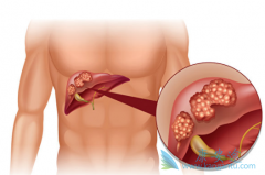 ������������atezolizumab�������ڳ���ΰ����ٴ��о�