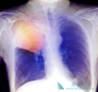 ��������(Lorlatinib)����ת�ƻ��ߵ���Ч�ʸߴ�90%