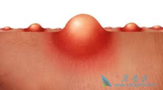 软组织肉瘤 软组织肉瘤