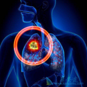 ��ת�ƻ���ʹ�ò�������(Brigatinib)��õ�ORR����