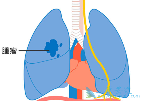 非小细胞肺癌 非小细胞肺癌
