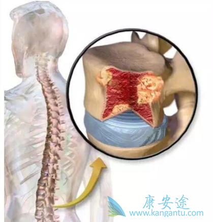 多发性骨髓瘤 多发性骨髓瘤