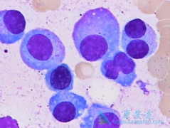 Daratumumab���Ƴ���෢�Թ�����Ч����ô����