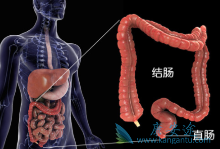 结直肠癌 结直肠癌