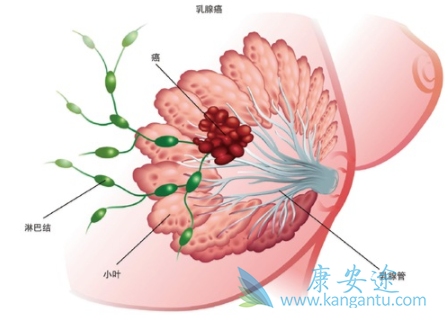 乳腺癌 乳腺癌