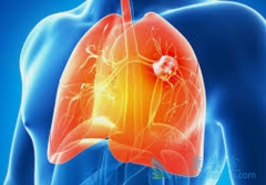 ����ALK���Էΰ��İ���ҩ�����ĸ�����Ч����ã�