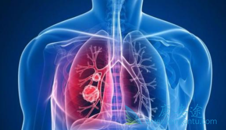 中药治疗肺癌 中药治疗肺癌