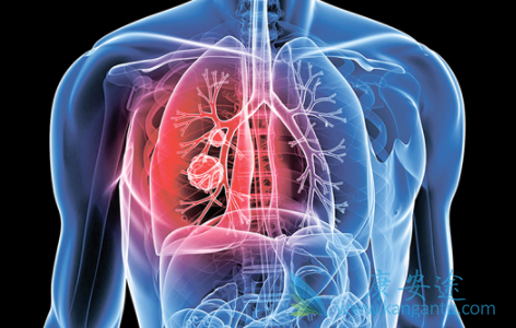 肺癌早期症状 肺癌早期症状