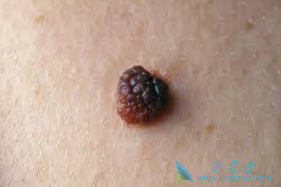 黑色素瘤 黑色素瘤