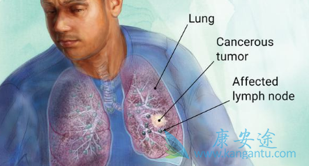非小细胞肺癌 非小细胞肺癌