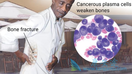 多发性骨髓瘤 多发性骨髓瘤