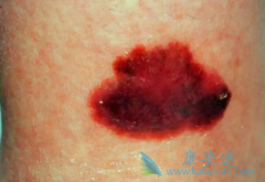 ��ķ�������ƺ�ɫ����Ч��Զ��Ipilimumab��