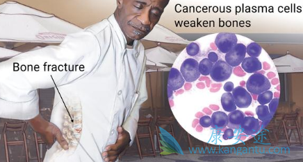 多发性骨髓瘤 多发性骨髓瘤