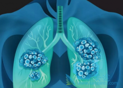 Ϊʲô���ڰ�������(alectinibum)�ĸ�ҩ�������ձ���ͬ��