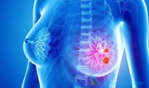 乳腺癌 乳腺癌