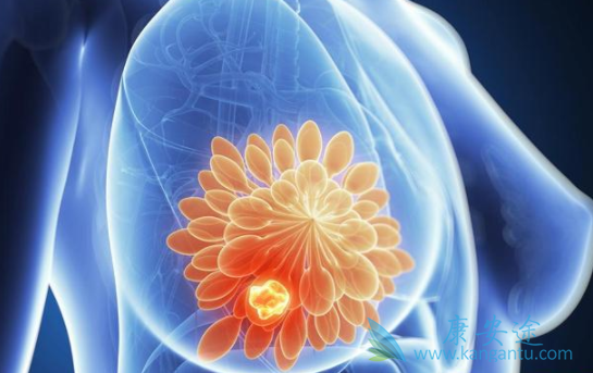 乳腺癌 乳腺癌
